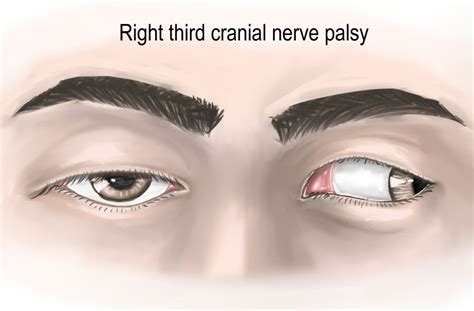 Cranial Nerve Palsy Cn Iii Iv Vi Vii Palsy 53 Off