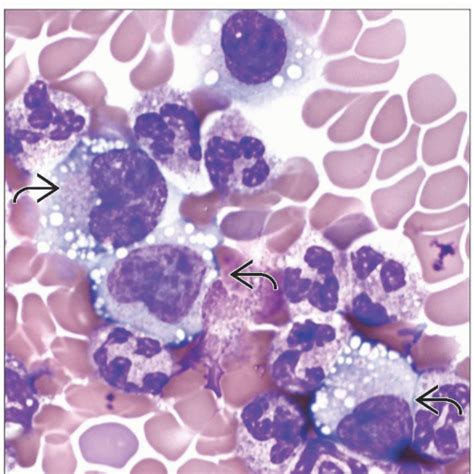 Anaplastic Large Cell Lymphoma In Blood And Bone Marrow Basicmedical Key