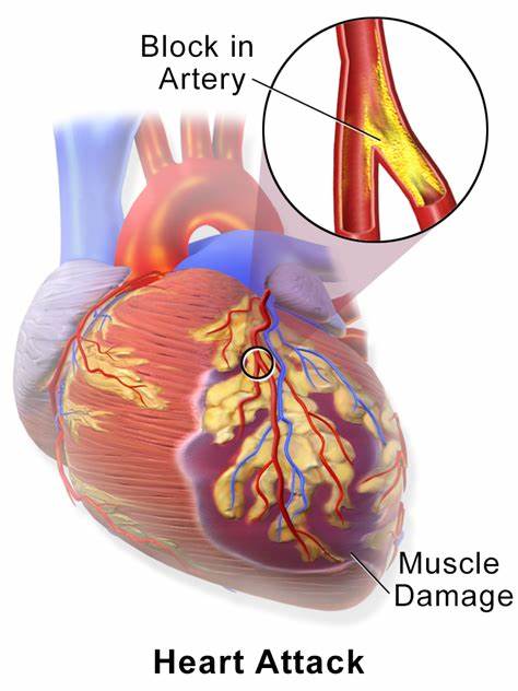 Vitamin D might safeguard heart tissue and forestall cardiovascular breakdown after coronary failure
