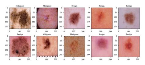 Images Of Malignant And Benign Skin Cancer Download Scientific Diagram