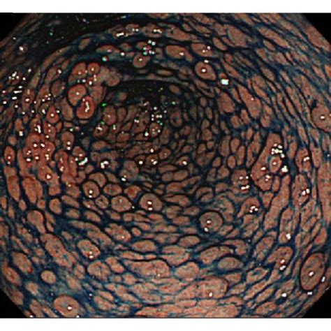 Capsule Endoscopy Revealed Polyps Of Normal Color In The Jejunum