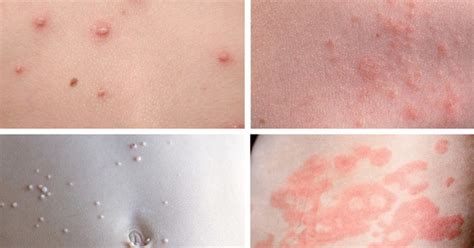 Children Rashes And Spots With Pictures Madeformums