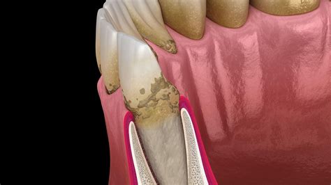 Study Suggests Path Connecting Periodontal Disease With Rheumatoid