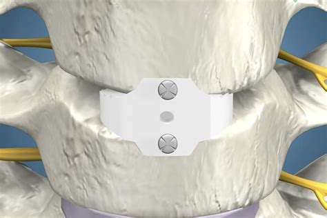 Cervical Discectomy