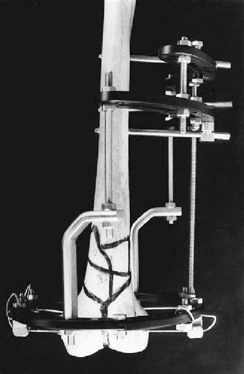 Photograph Showing The Mounting Of The Ilizarov External Fixator For