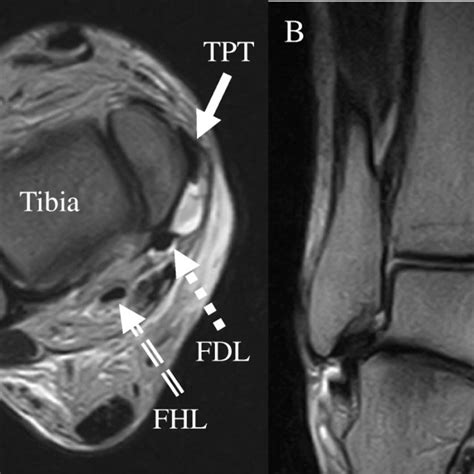 Magnetic Resonance Imaging Demonstrates An Anterior Subluxated Tibialis