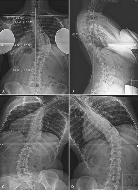 A Case Study Approach To The Role Of Spinal Deformity Correction In The