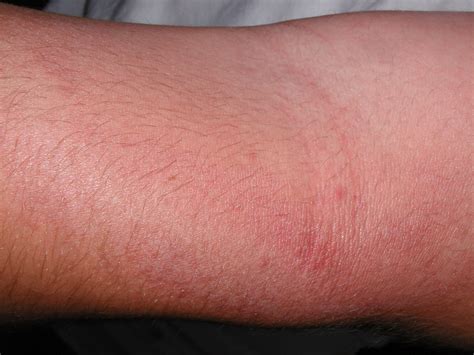 Heat Rash Bumps On Arms Images And Photos Finder