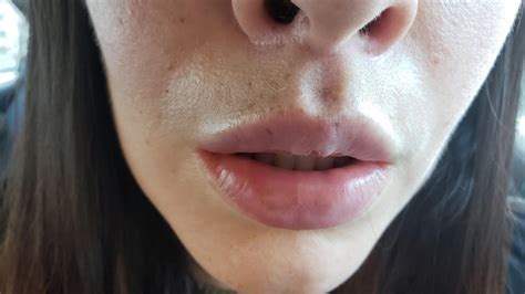 Lip Lift Scar Is My Scar Widening 6 Months Post Op Rplasticsurgery