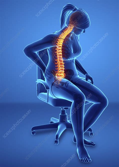 Woman With Back Pain Illustration Stock Image F0225974 Science
