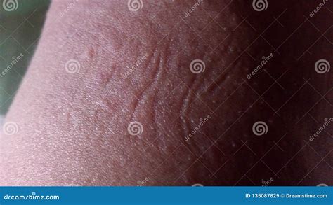 Skin Rashes Stock Image Image Of Common Skin Rash 135087829