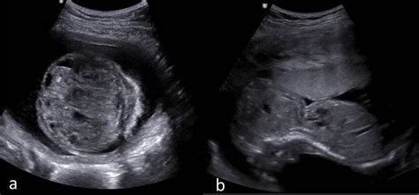 Ultrasound Images Showing Solid Cystic Mass Extending From Anterior
