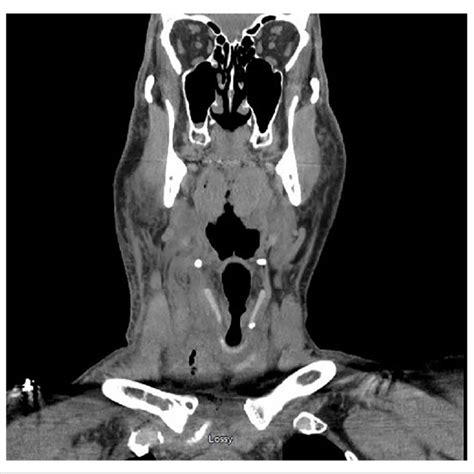 Computed Tomography Neck Without Contrast Coronal View Showing Right