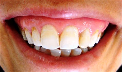 Using Microabrasion And In Office Bleaching To Treat Fluorosis In