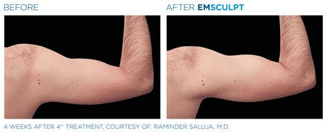 New At Ps Emsculpt For Your Arms And Calves Project Skin Md