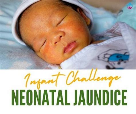 Neonatal Jaundice And Breastfeeding Nursing Moms