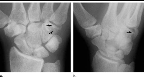 Hamate Fracture A Pa Radiograph Of The Right Wrist Demonstrates An