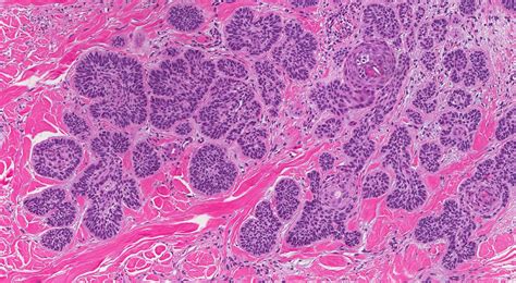 Micronodular Basal Cell Carcinoma MyPathologyReport Ca