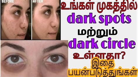 How To Get Rid Of Darkspots And Dark Circles Cure Discoloration Of