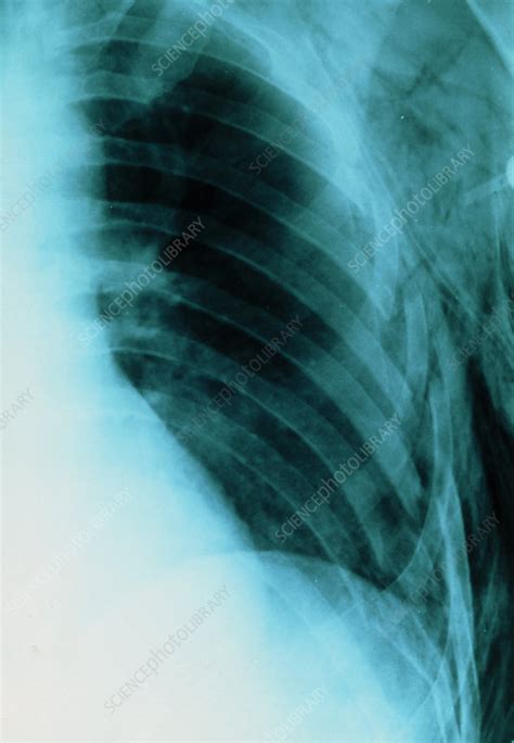 Coloured Chest X Ray Of Fractured Ribs Stock Image M3300755