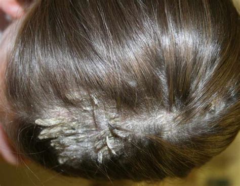 Psoriasis Scalp Psoriasis