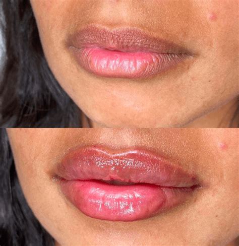7 Lip Filler Before And After Shots You Have To See Ovme