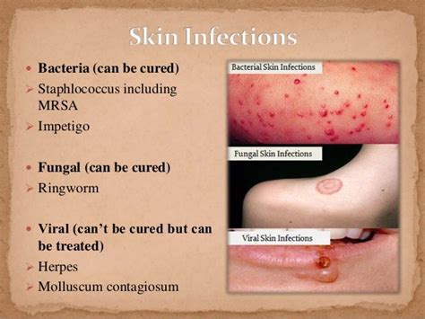 Skin Infection In Wrestlers
