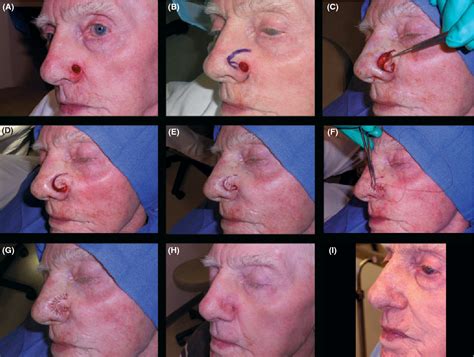 Figure 3 From The Spiral Flap For Nasal Alar Reconstruction Our