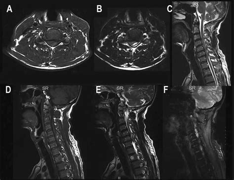 Axial T1w A And T2w B Mr Images Showing The Extradural Hematoma