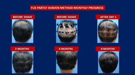 Harley street hair clinic provide bespoke treatments. FUE HAIR TRANSPLANT GOOGLE | hairtransplantcentremalaysia.com