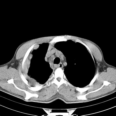 Based on the findings, you may undergo further testing to determine whether mesothelioma or another disease is causing your symptoms. Malignant Mesothelioma Versus Metastatic Carcinoma of the ...