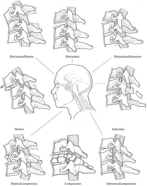 Lower Cervical Spine Injuries Musculoskeletal Key