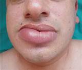 Allergic Reaction Swollen Tongue Treatment Images