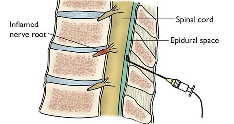 Lumbar Epidural Steroid Injections Archives Spinal Backrack
