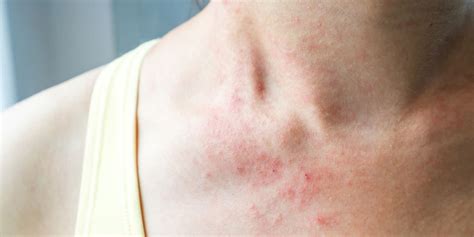 A Skin Rash May Be A New Rare Symptom Of Coronavirus According To Doctors