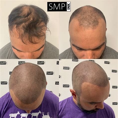 When there is maintenance, it is generally. Scalp Micropigmentation Before and After Photos - SMP INK