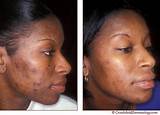 Laser Treatment For Acne Scars On Black Skin Pictures