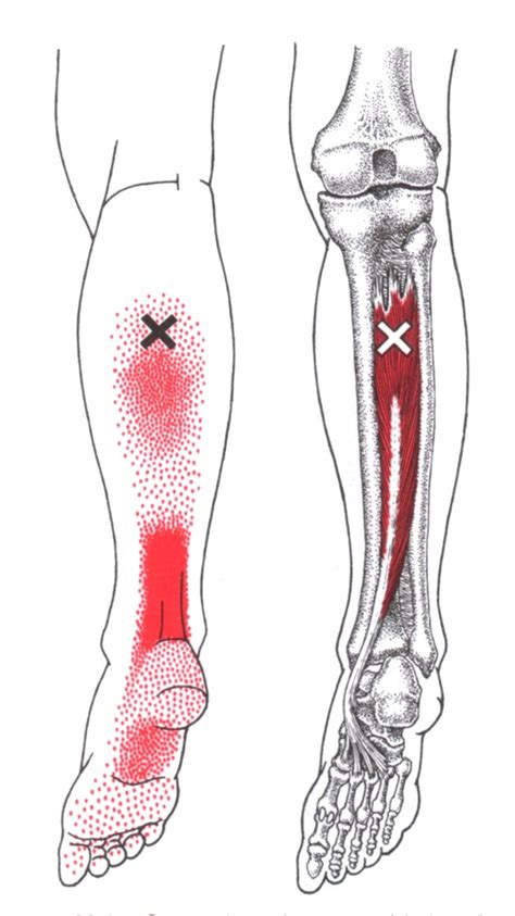 The Trigger Point And Referred Pain Guide 6