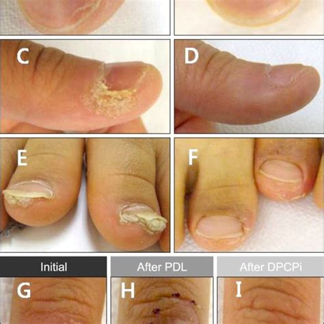 Wart Underneath Fingernail Bed Tutorial Pics
