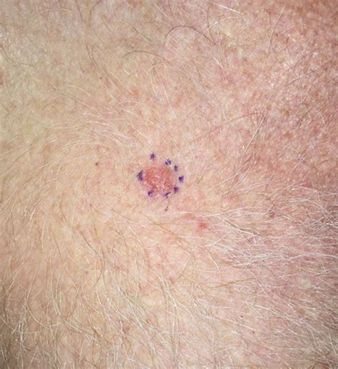 Cureus Lichenoid Keratosis Skin Biopsy A Case Report Of Malignant