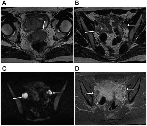 Neuroendocrine Carcinoma Of Uterine Cervix Findings Shown By Mri For