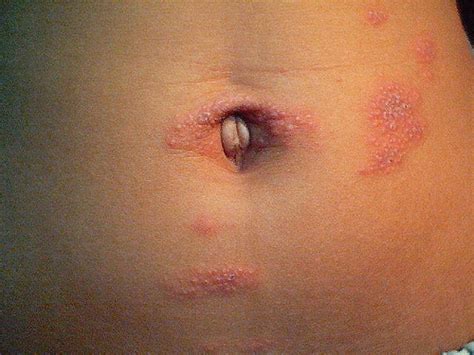 Pityriasis Rosea Medical Pictures Info Health Definitions Photos