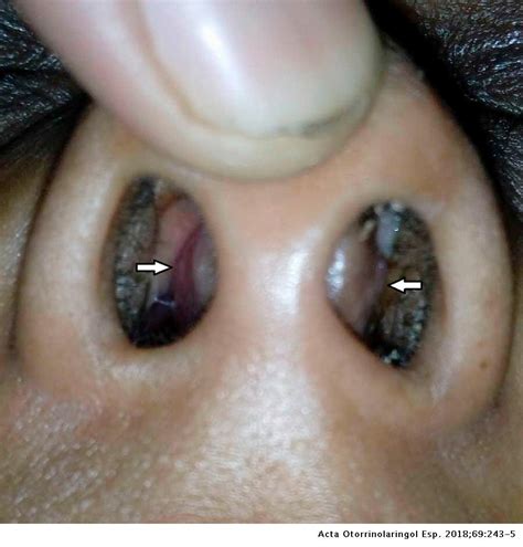 Primary Tuberculosis Of The Nasal Septum The Non Ulcerated Form Presenting As Septal Thickening