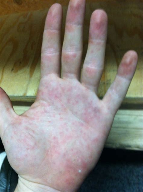 Bumps On My Hand General
