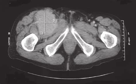 Axial Ct Of The Pelvis Showing A Lymph Node In The Right Inguinal