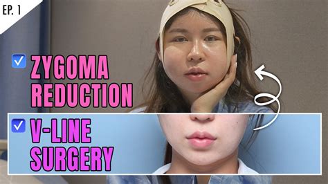 Sub Zygoma And Jawline Reduction Plastic Surgery Review Vlog In Korea