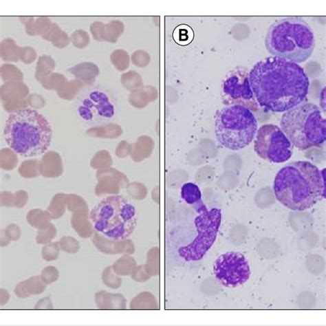 Morphology In A Patient Of Chronic Eosinophilic Leukemia With A