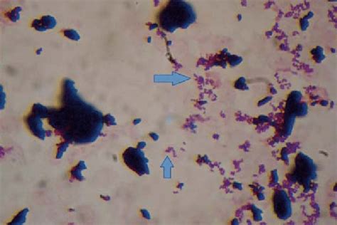 Gram Stain Preparation Of The Positive Blood Culture Examined With 100x