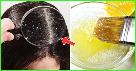 Let's take a closer look at some of these ingredients to see how they help with hair loss. 15 Effective Hair Masks For Dandruff