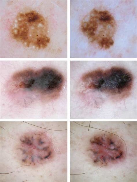 Appearance Of Seborrheic Keratosis A And B Melanoma C And D And